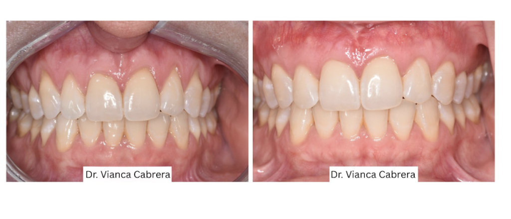 restoring the gums on the upper teeth, Dr. Cabrera